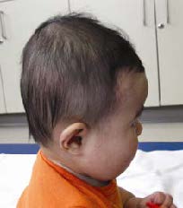 Child showing plagiocephaly